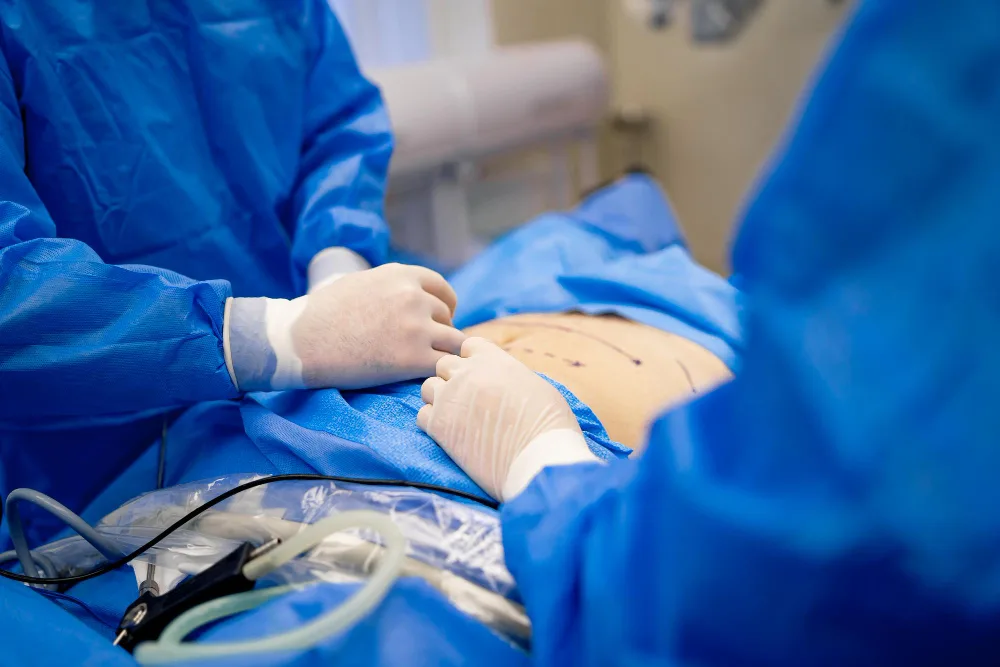 Hernia abdominal
