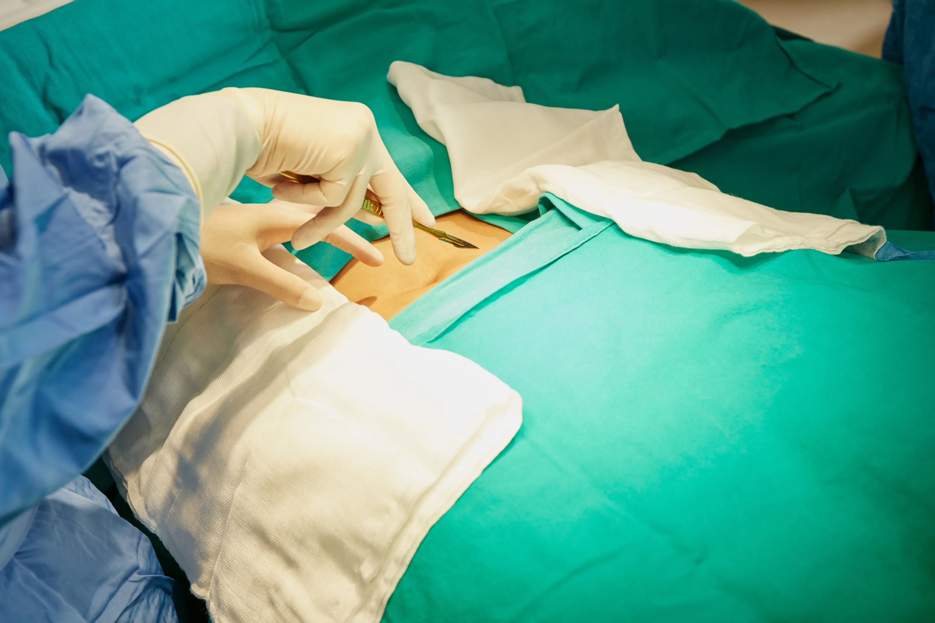 Hernia umbilical
